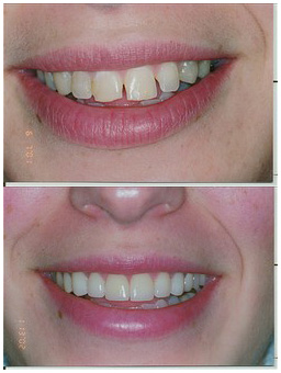 Veneers | Dentist In Daphne, AL | Southern Dentistry